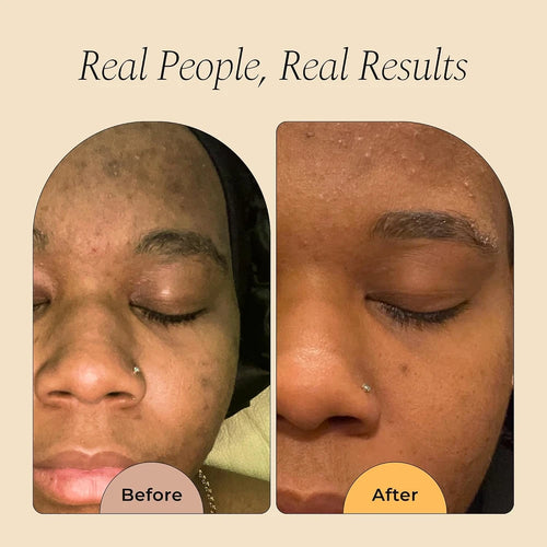 Turmeric Dark Spot Remover Soap