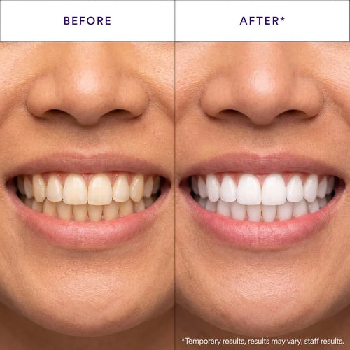 V34 Colour Correcting Whitening Strips | Professional Teeth Whitening Kit with PAP+ Technology