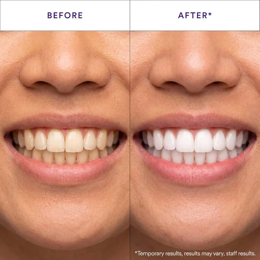 V34 Colour Correcting Whitening Strips | Professional Teeth Whitening Kit with PAP+ Technology